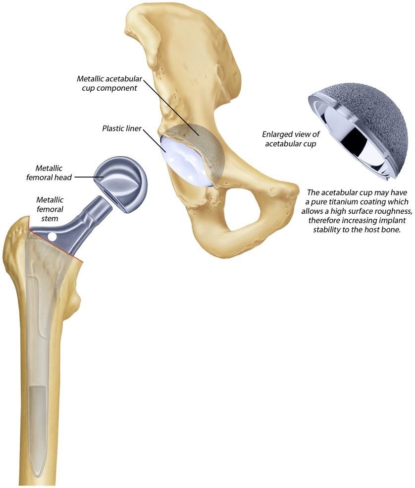 Hip Replacement Surgery – Dr Benjamin Hewitt