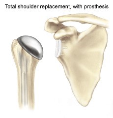 Shoulder Replacement – Dr Benjamin Hewitt